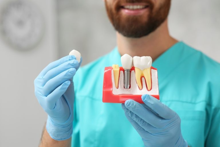Dentist,Holding,Educational,Model,Of,Dental,Implant,On,Blurred,Background,