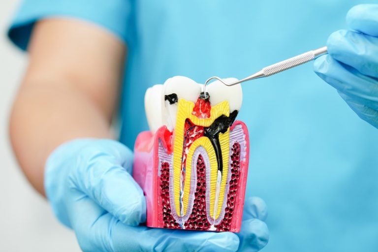 Dental,Implant,,Artificial,Tooth,Roots,Into,Jaw,,Root,Canal,Of